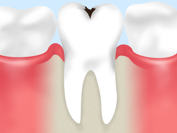 虫歯の原因を知っていますか？