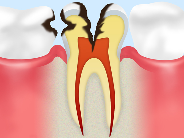 【C3：神経に達した虫歯】